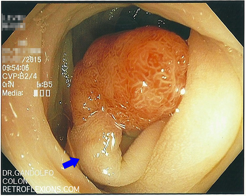sigmoid-polyp-before